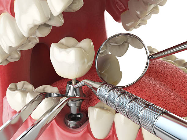 Best Dental Abscess Treatment in Wadesboro, NC